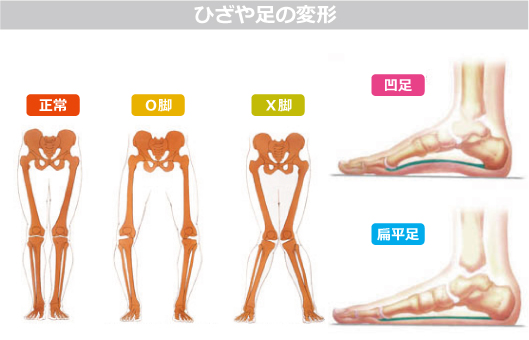 原因 x 脚 X脚はなぜ起きてしまうの？X脚の原因と改善法を徹底解説！